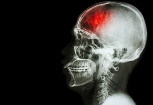 A Importância da Terapia de Reabilitação para Pacientes com AVC