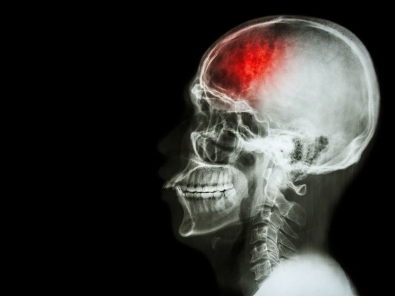 A Importância da Terapia de Reabilitação para Pacientes com AVC