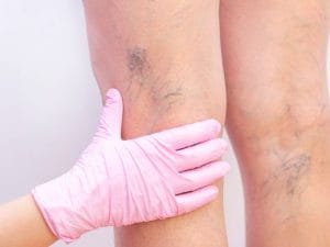 Clínica para Tratamento de Varizes em Biguaçu