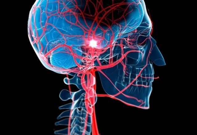 Como Prevenir Acidentes Vasculares Cerebrais com Cuidados Regulares