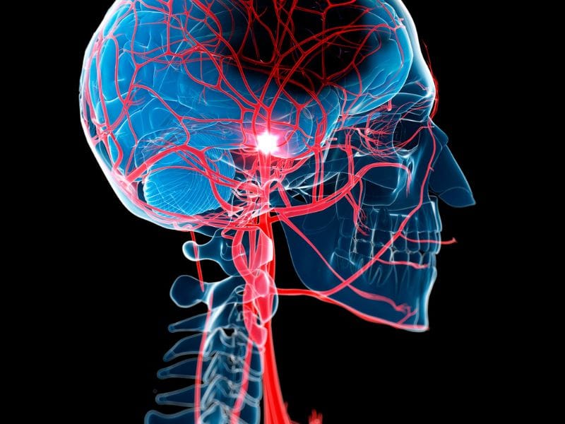 Como Prevenir Acidentes Vasculares Cerebrais com Cuidados Regulares