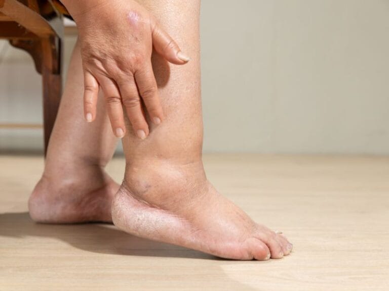 Linfedema Hereditário em Florianópolis Entenda os Cuidados Necessários (1)