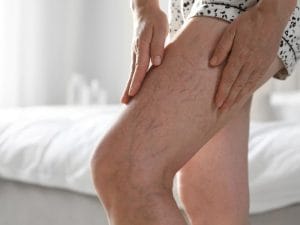 Melhor Clínica para Tratamento de Varizes em Florianópolis