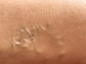 Onde Realizar Tratamento de Varizes em São José
