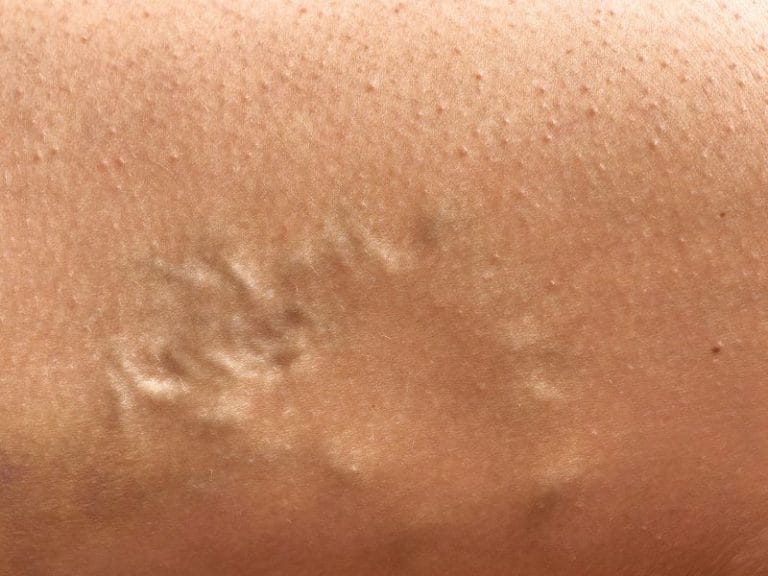 Onde Realizar Tratamento de Varizes em São José