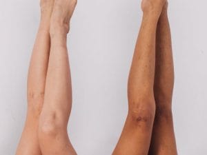 Tratamento de Varizes nas Pernas em Biguaçu
