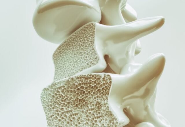 Tratamento de osteoporose em Florianópolis