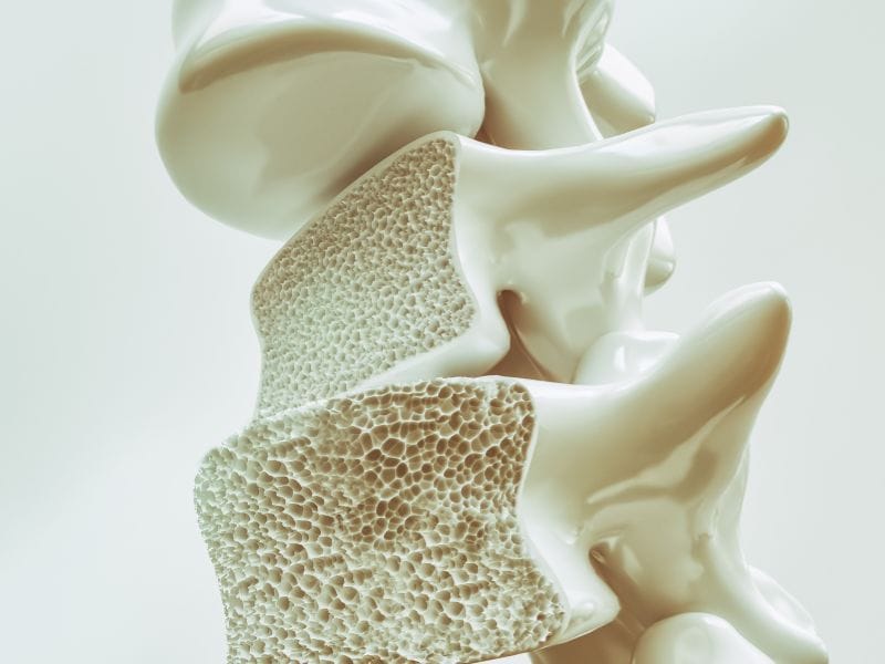 Tratamento de osteoporose em Florianópolis