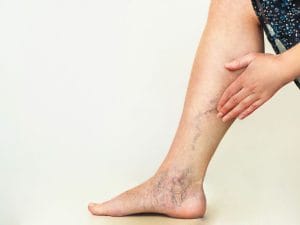 Tratamento de Varizes Sem Cirurgia em Palhoça