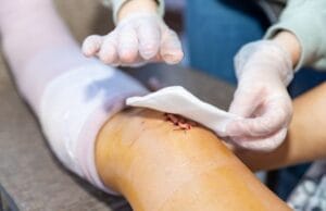 Tratamento de Feridas na Perna em São José